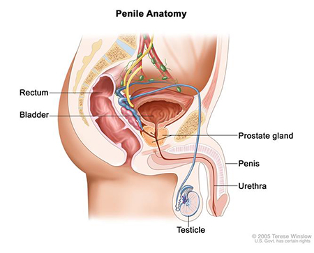 Penile Cancer